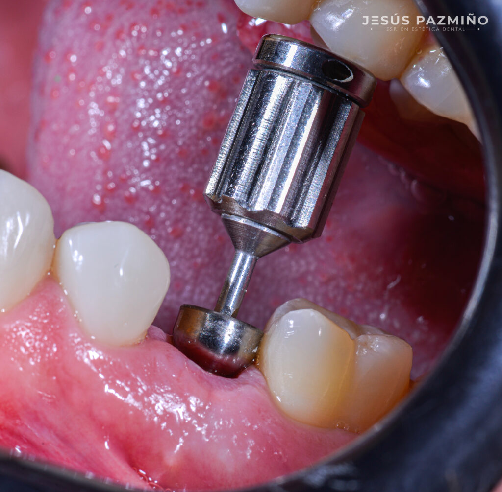 Implantes ClinicaSmileForever